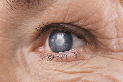 Glaucoma Optometrist 07856